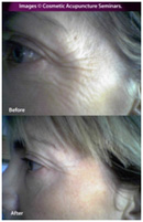 Cosmetic Acupuncture Treatment Before & After 1